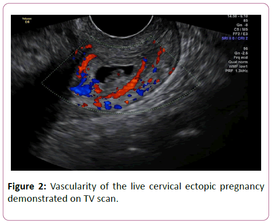 Management Of Live Cervical Ectopic Pregnancy