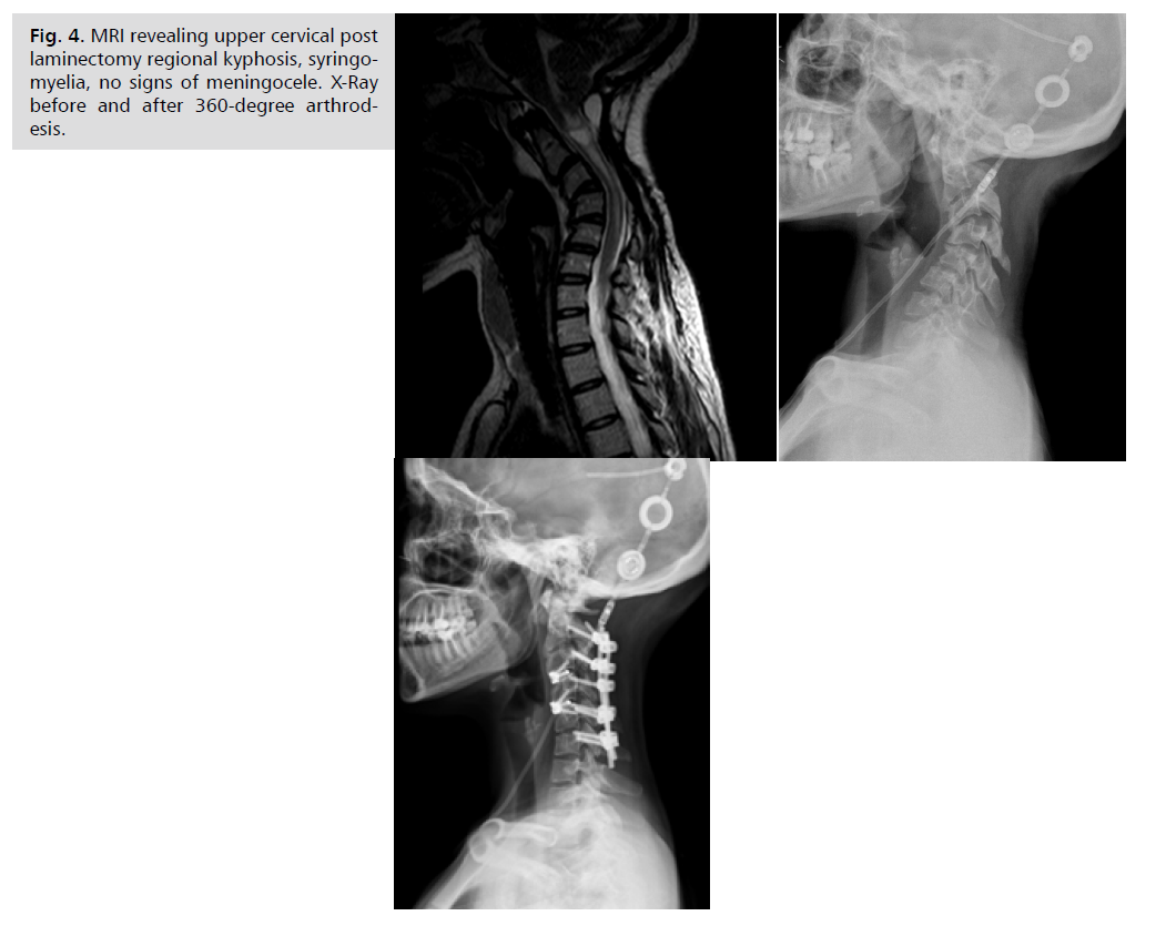 neurology-neuroscience-laminectomy