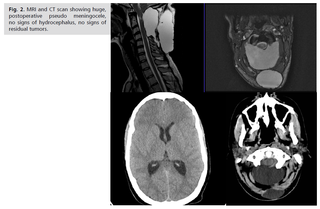 neurology-neuroscience-meningocele