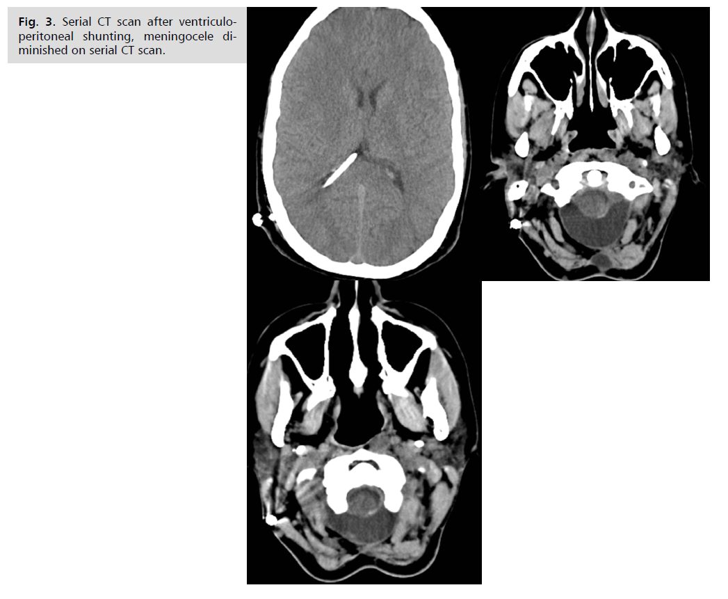 neurology-neuroscience-meningocele