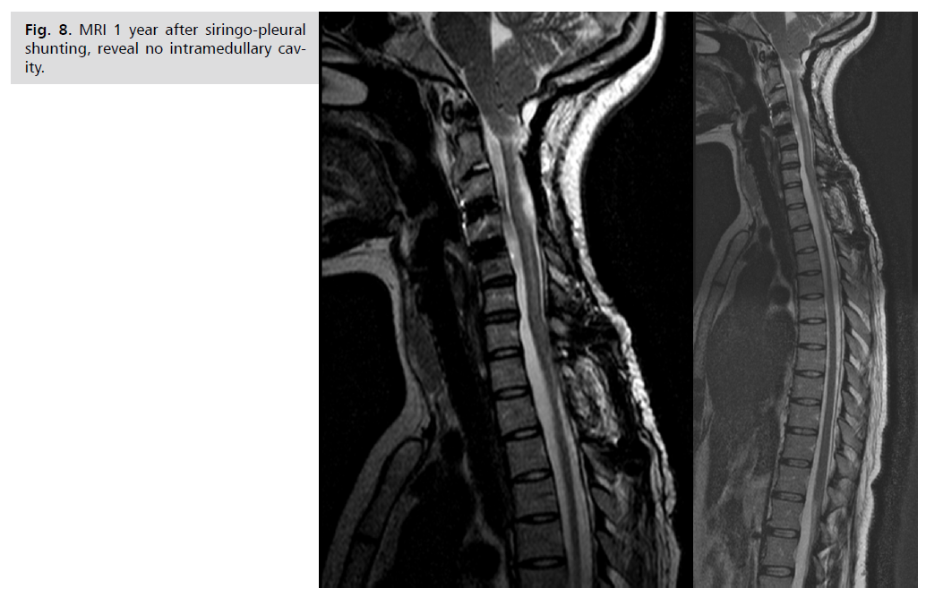 neurology-neuroscience-siringo-pleural