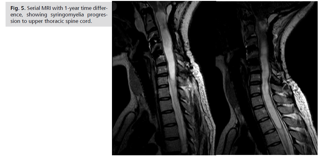 neurology-neuroscience-syringomyelia