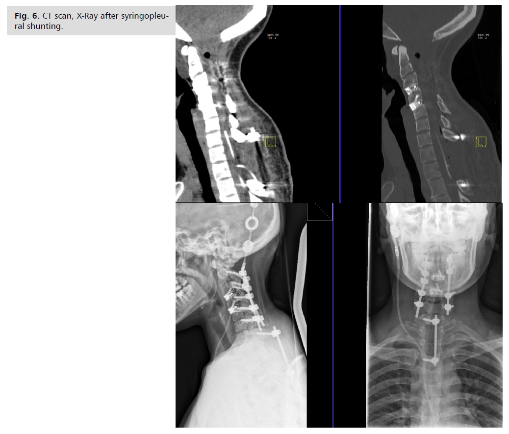 neurology-neuroscience-syringomyelia