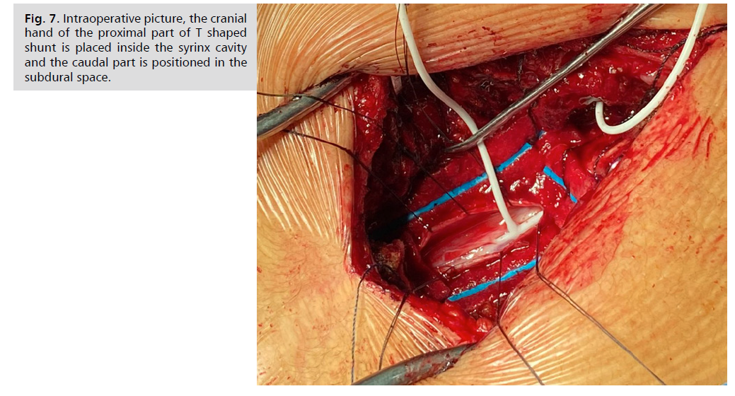 neurology-neuroscience-syrinx-cavity