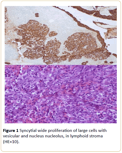 Archives-Cancer-Research-Pleomorphic-cellular