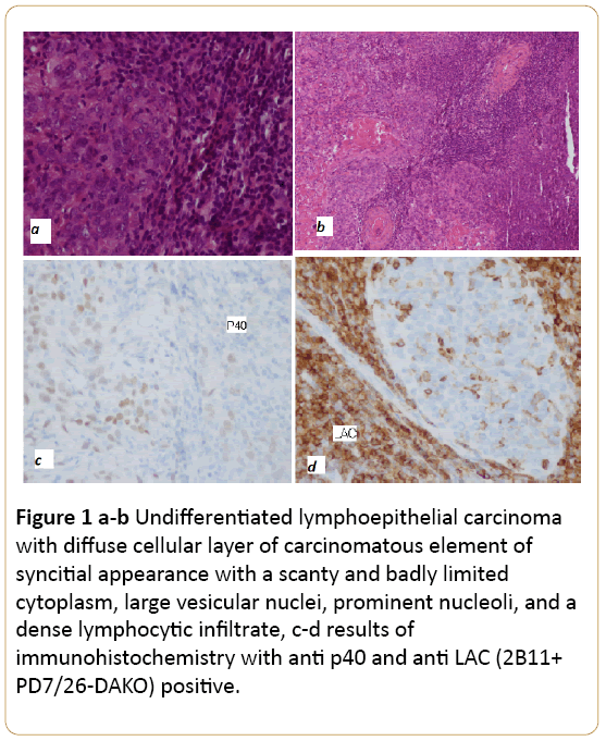 Archives-Cancer-Research-lymphoepithelial-carcinoma