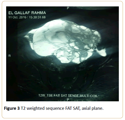 acanceresearch-weighted-sequence-FAT-SAT-axial-plane