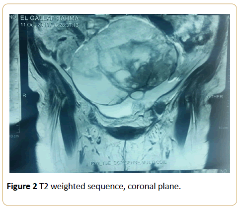 acanceresearch-weighted-sequence-coronal-plane