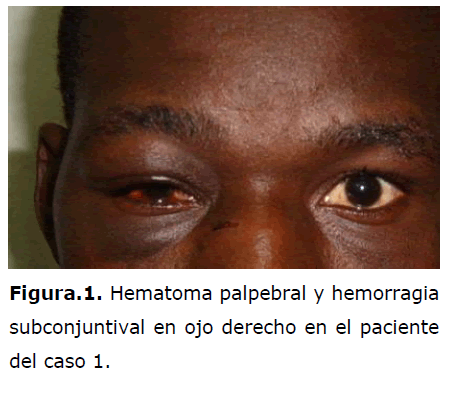 archivosdemedicina-Hematoma-palpebral