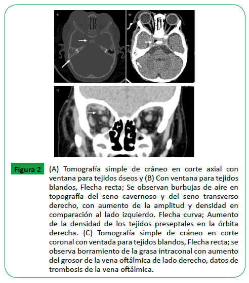 archivosdemedicina-seno-cavernoso