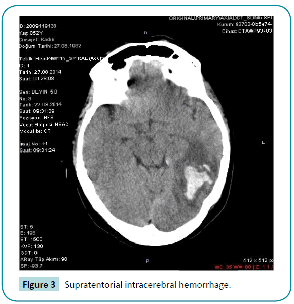 biomedical-sciences-Supratentorial-intracerebral