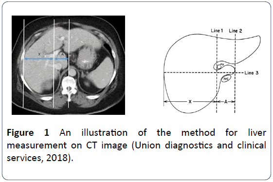 Computed Tomography Evaluation Of The Caudate to Right Lobe Ratio In 