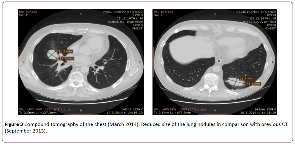 jneuro-Reduced-size-lung-nodules