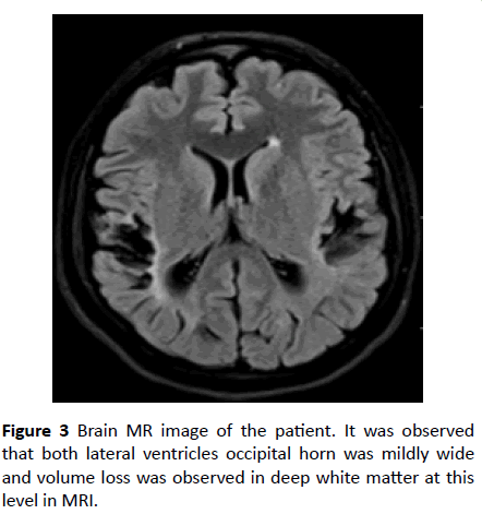 jneuro-lateral-ventricles