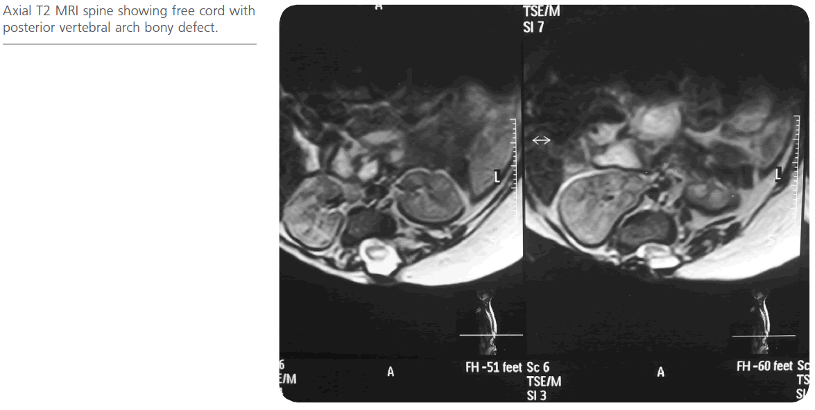 jneuro-posterior-vertebral