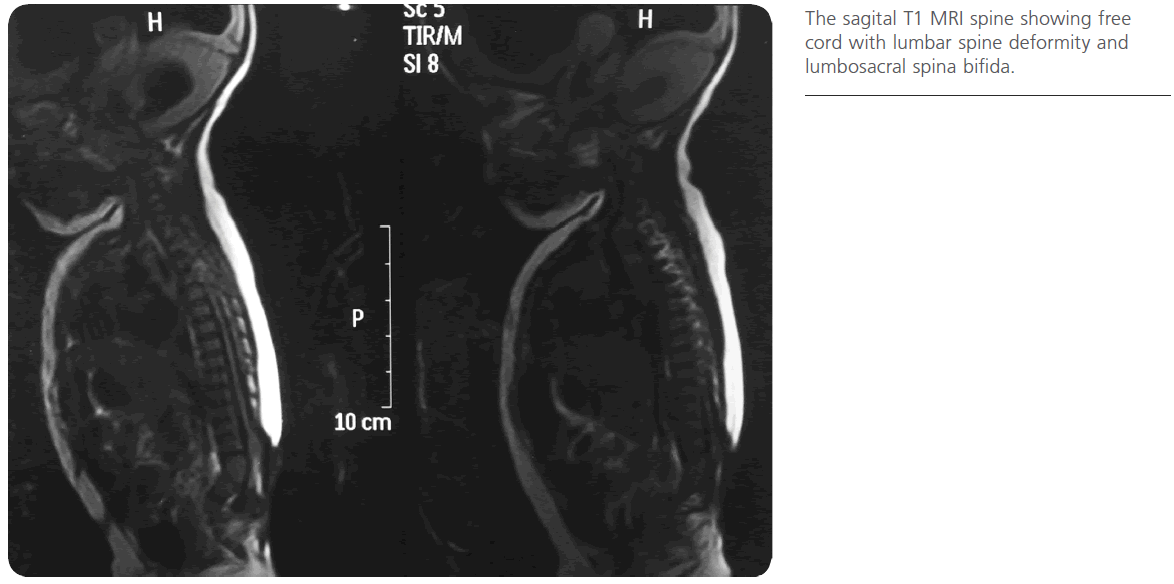 jneuro-sagital-T1-MRI-spine