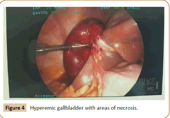 jusurgery-Hyperemic-gallbladder
